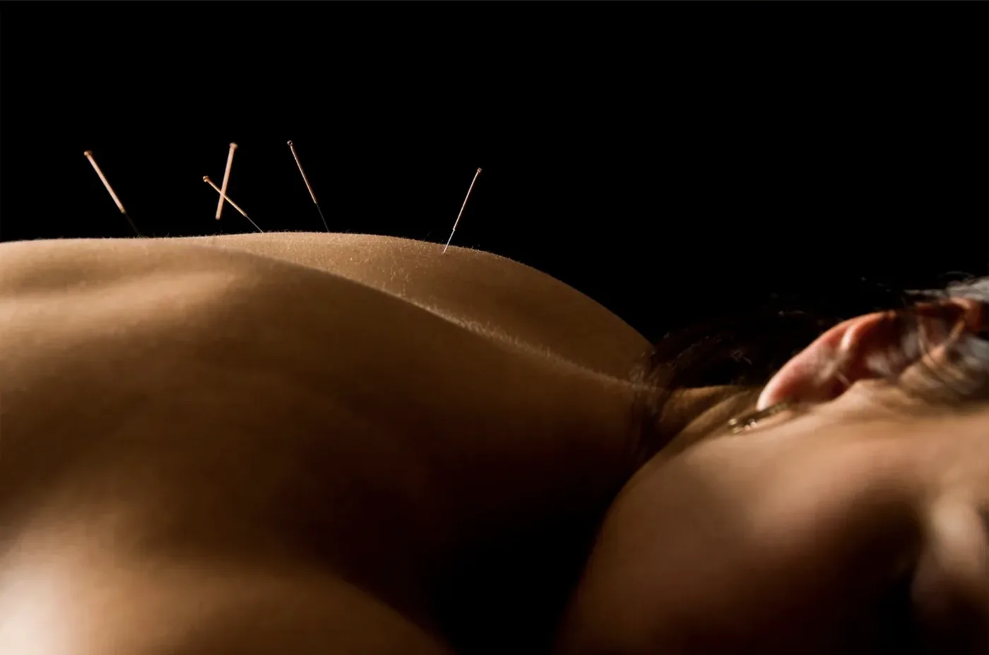 Dr. Yasmin Harounian performing acupuncture treatment with stem cell activation therapy in Los Angeles